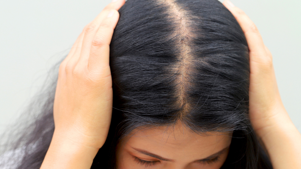 Alopecia androgénica femenina