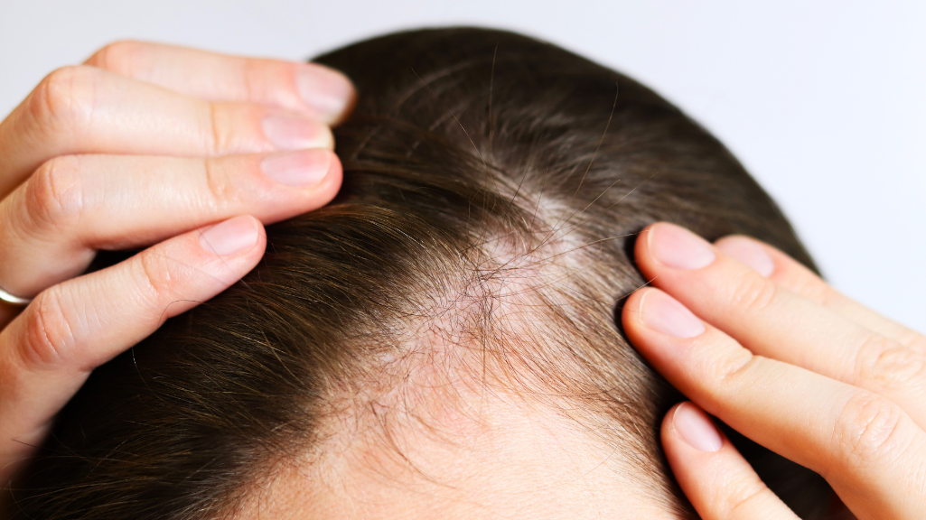 Alopecia androgénica femenina